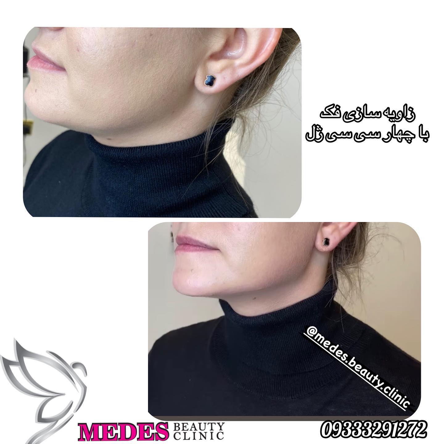 گالری زاویه سازی صورت